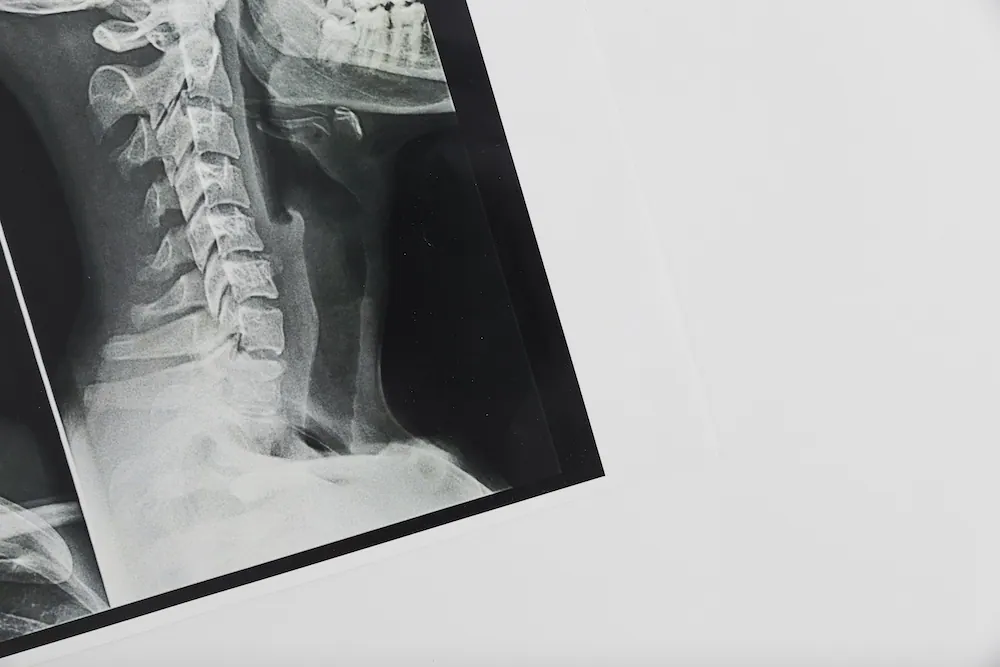 a spinal X ray result