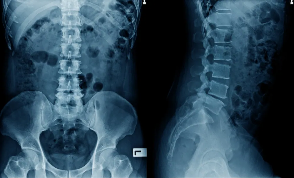 leg and back spinal X-ray