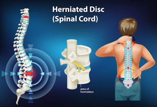 Herniated Disc